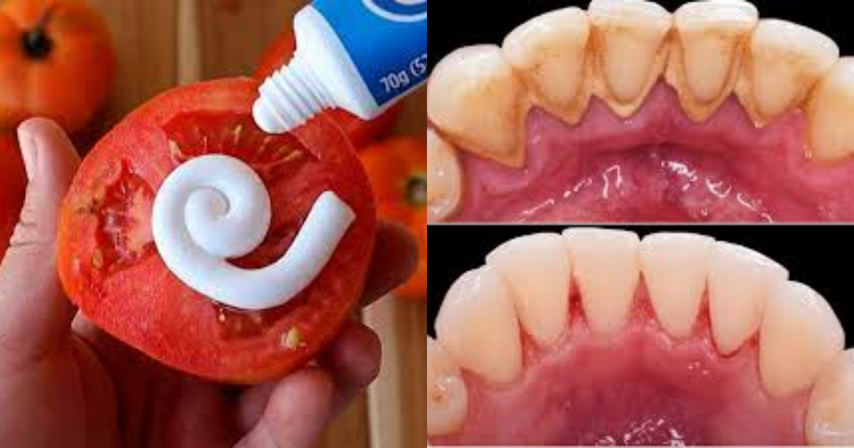 Home Remedy For Teeth Whitening