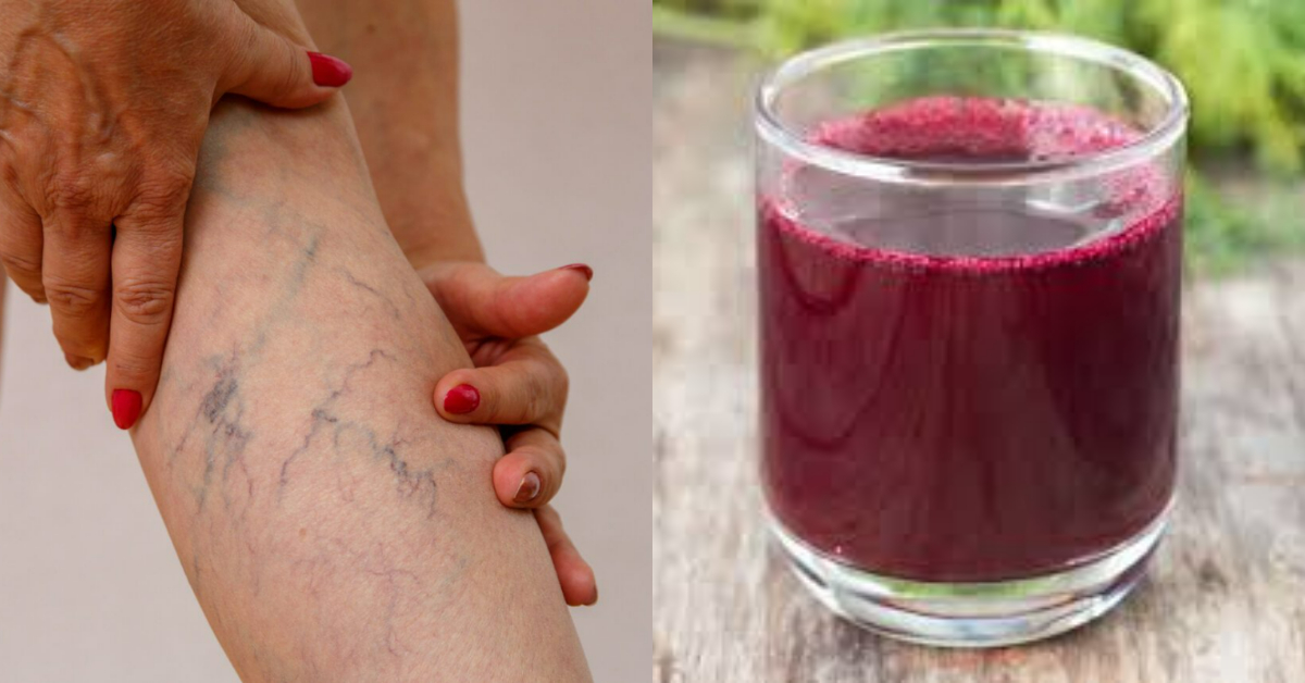 Varicose Veins Treatment At Home